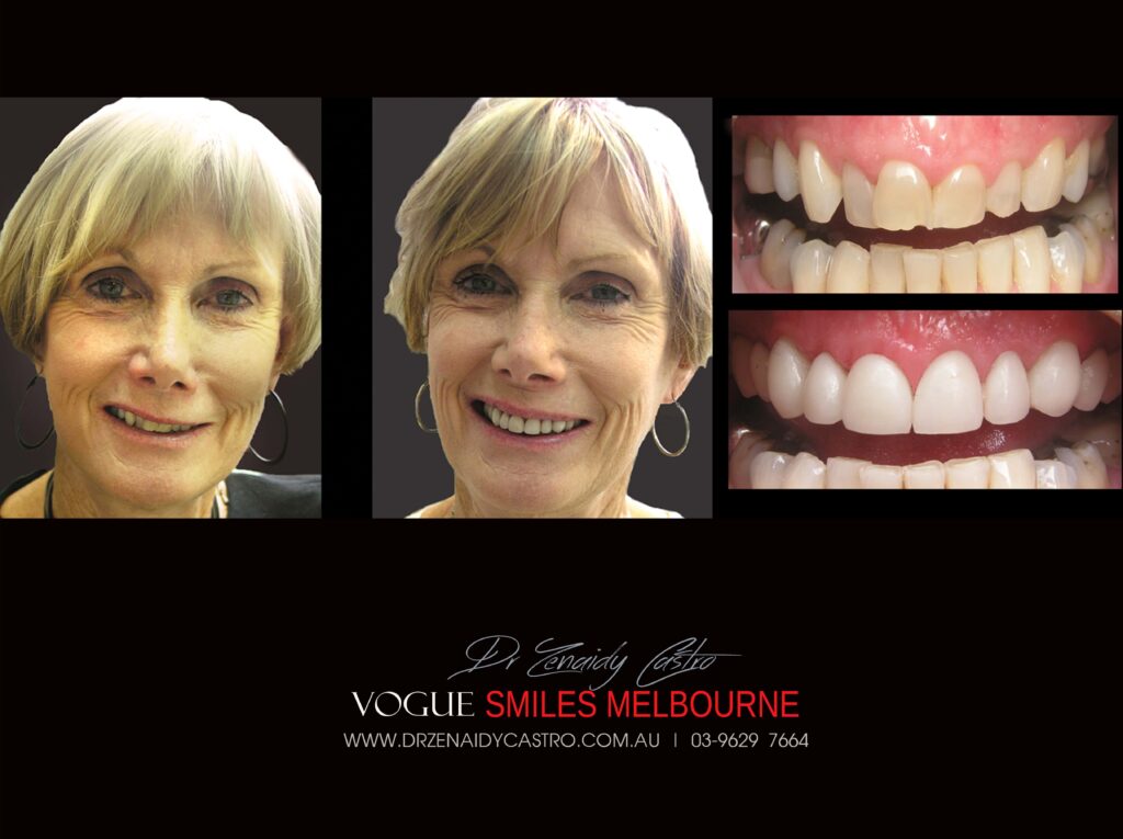 Vogue Smiles Melbourne - Vogue Dentist - Vogue Dental Melbourne -Best Cosmetic dentist in Melbourne CBD