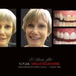 Vogue Smiles Melbourne - Vogue Dentist - Vogue Dental Melbourne -Best Cosmetic dentist in Melbourne CBD