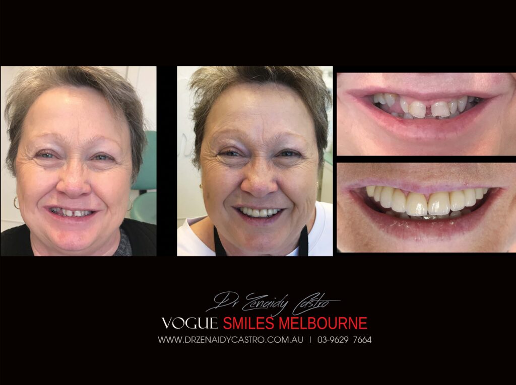 Vogue Smiles Melbourne - Vogue Dentist - Vogue Dental Melbourne -Best Cosmetic dentist in Melbourne CBD