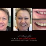VOGUE-SMILES-COSMETIC-DENTISTRY-TREATMENT-4-scaled.jpg