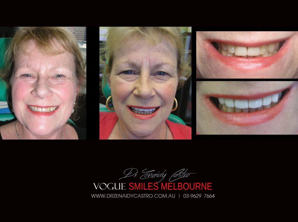 VOGUE-SMILES-COSMETIC-DENTISTRY-TREATMENT-40-scaled.jpg