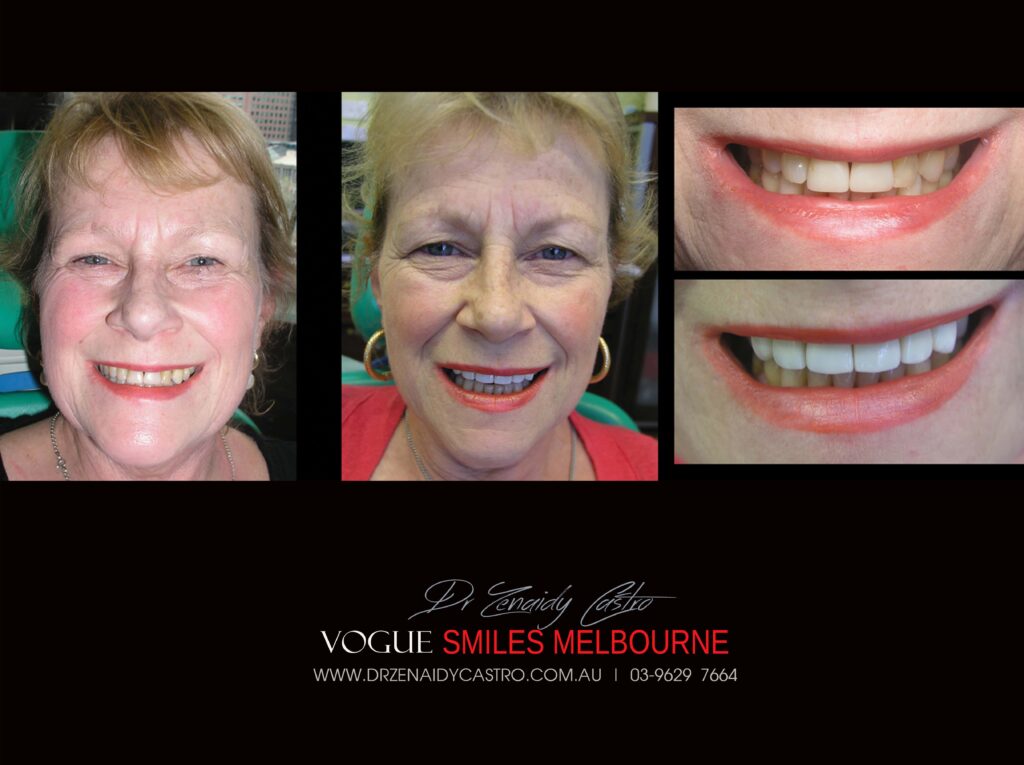 Vogue Smiles Melbourne - Vogue Dentist - Vogue Dental Melbourne -Best Cosmetic dentist in Melbourne CBD