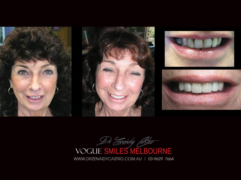 Vogue Smiles Melbourne - Vogue Dentist - Vogue Dental Melbourne -Best Cosmetic dentist in Melbourne CBD