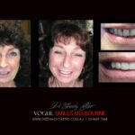 VOGUE-SMILES-COSMETIC-DENTISTRY-TREATMENT-42-scaled.jpg