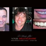 VOGUE-SMILES-COSMETIC-DENTISTRY-TREATMENT-44-scaled.jpg