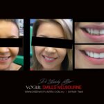 VOGUE-SMILES-COSMETIC-DENTISTRY-TREATMENT-45-scaled.jpg