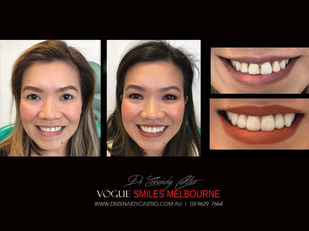 Vogue Smiles Melbourne - Vogue Dentist - Vogue Dental Melbourne -Best Cosmetic dentist in Melbourne CBD