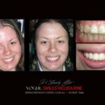 VOGUE-SMILES-COSMETIC-DENTISTRY-TREATMENT-49-scaled.jpg