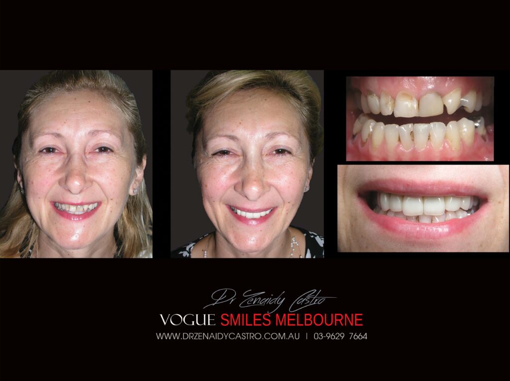 Vogue Smiles Melbourne - Vogue Dentist - Vogue Dental Melbourne -Best Cosmetic dentist in Melbourne CBD