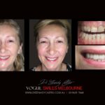 VOGUE-SMILES-COSMETIC-DENTISTRY-TREATMENT-52-scaled.jpg