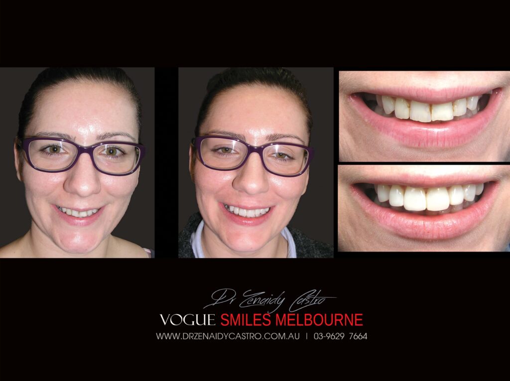 Dental Bonding Before and After Photos Melbourne | Composite Resin Veneers before and after pictures Melbourne CBD