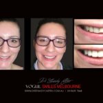 Dental Bonding Before and After Photos Melbourne | Composite Resin Veneers before and after pictures Melbourne CBD