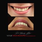 VOGUE-SMILES-COSMETIC-DENTISTRY-TREATMENT-55.jpg