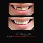 VOGUE-SMILES-COSMETIC-DENTISTRY-TREATMENT-56.jpg