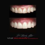 VOGUE-SMILES-COSMETIC-DENTISTRY-TREATMENT-61.jpg