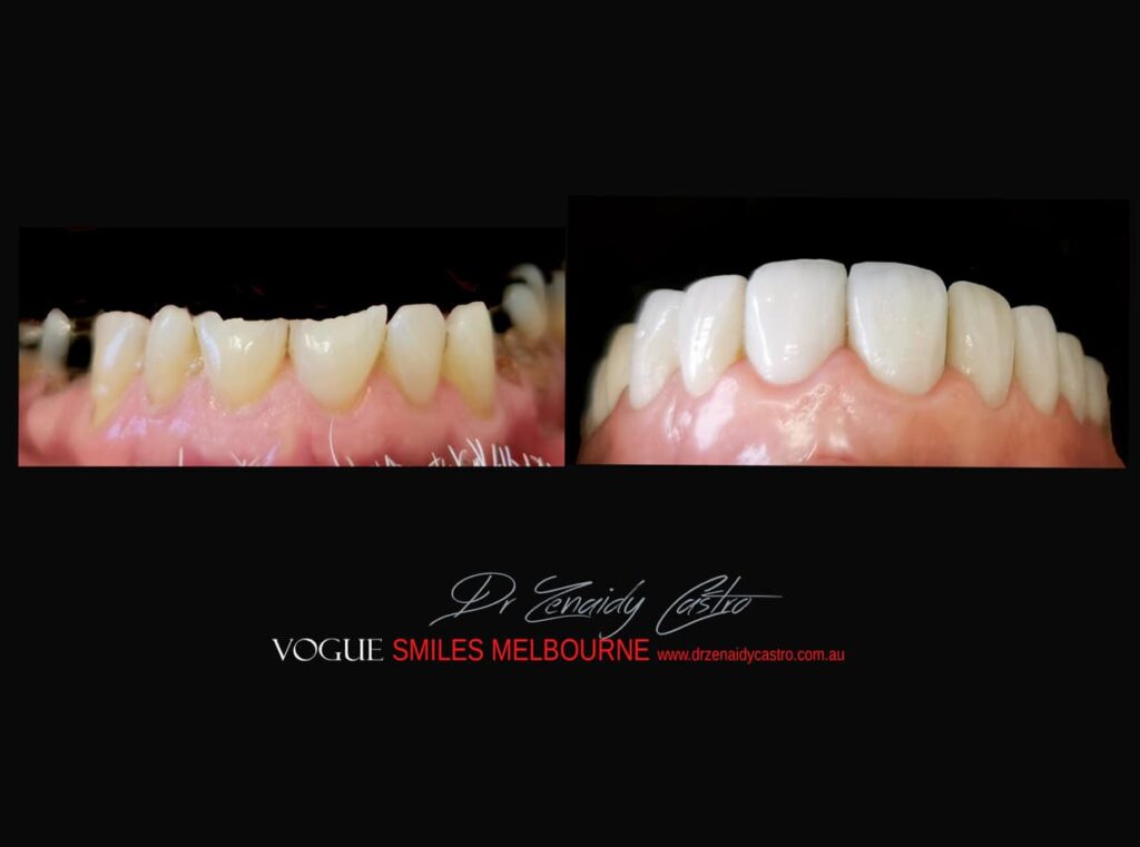 VOGUE-SMILES-COSMETIC-DENTISTRY-TREATMENT-62.jpg