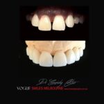 VOGUE-SMILES-COSMETIC-DENTISTRY-TREATMENT-64.jpg