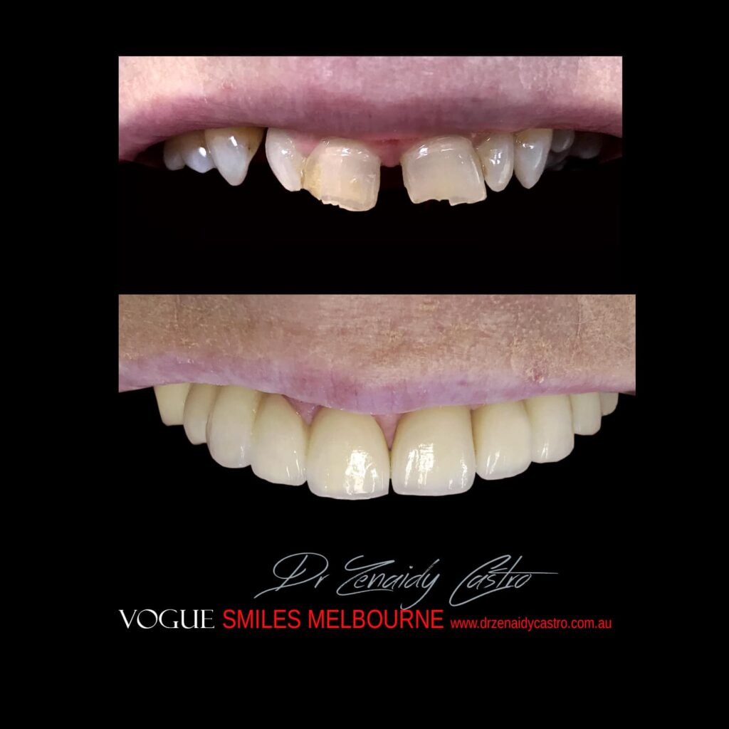 VOGUE-SMILES-COSMETIC-DENTISTRY-TREATMENT-65.jpg