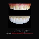 VOGUE-SMILES-COSMETIC-DENTISTRY-TREATMENT-67.jpg