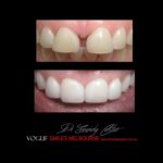 VOGUE-SMILES-COSMETIC-DENTISTRY-TREATMENT-68.jpg