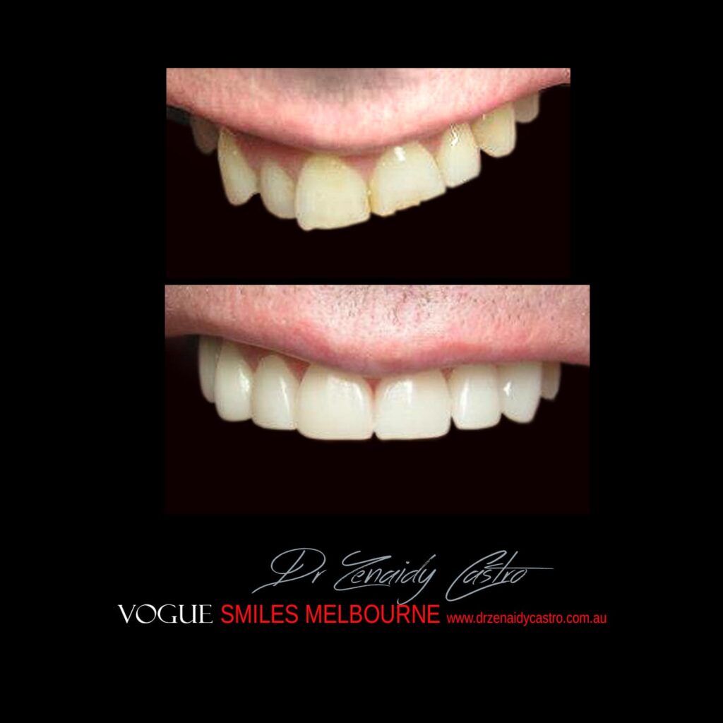 VOGUE-SMILES-COSMETIC-DENTISTRY-TREATMENT-69.jpg