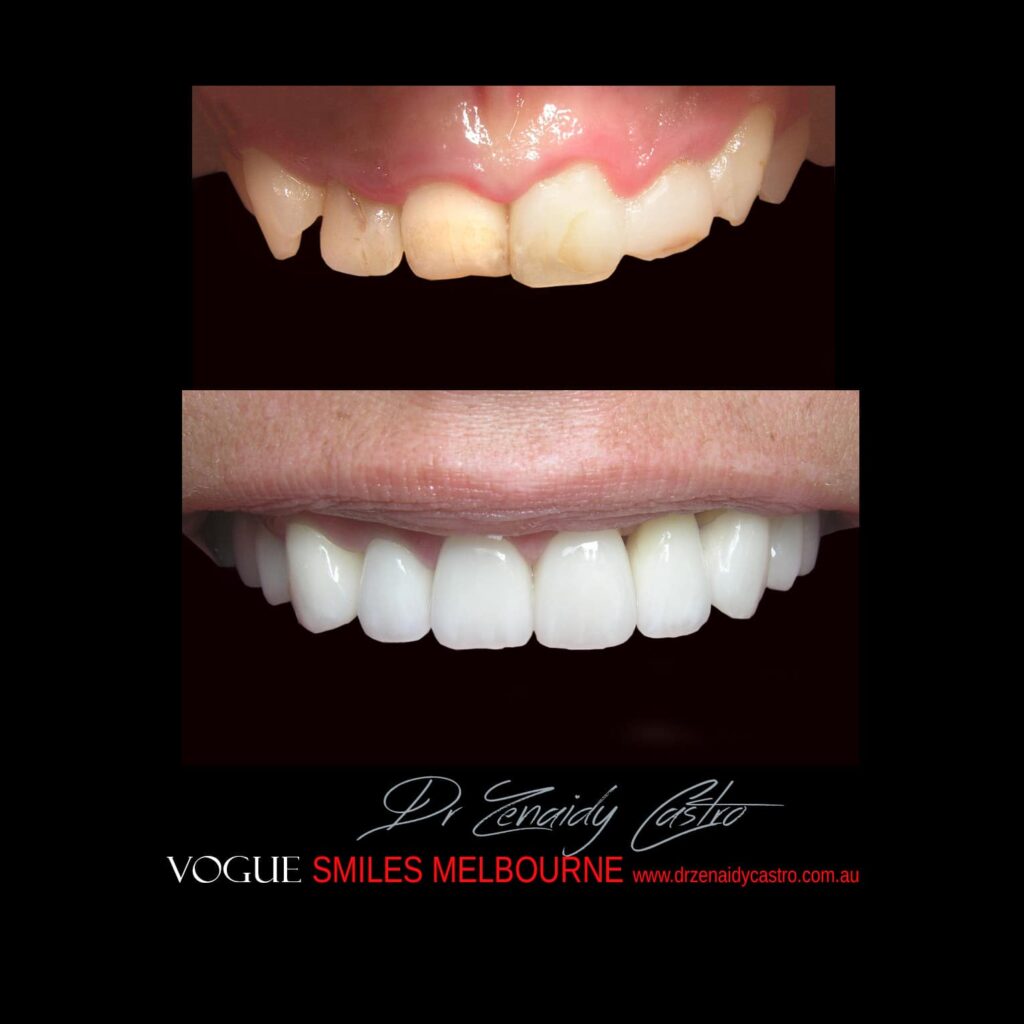 VOGUE-SMILES-COSMETIC-DENTISTRY-TREATMENT-70.jpg