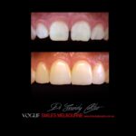 VOGUE-SMILES-COSMETIC-DENTISTRY-TREATMENT-72.jpg