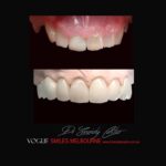 VOGUE-SMILES-COSMETIC-DENTISTRY-TREATMENT-73.jpg