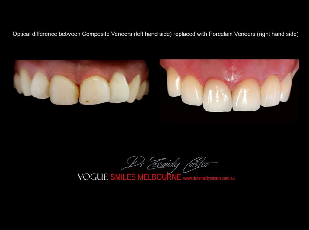 VOGUE-SMILES-COSMETIC-DENTISTRY-TREATMENT-75.jpg