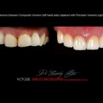 VOGUE-SMILES-COSMETIC-DENTISTRY-TREATMENT-75.jpg