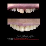 VOGUE-SMILES-COSMETIC-DENTISTRY-TREATMENT-77.jpg
