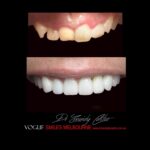 VOGUE-SMILES-COSMETIC-DENTISTRY-TREATMENT-80.jpg