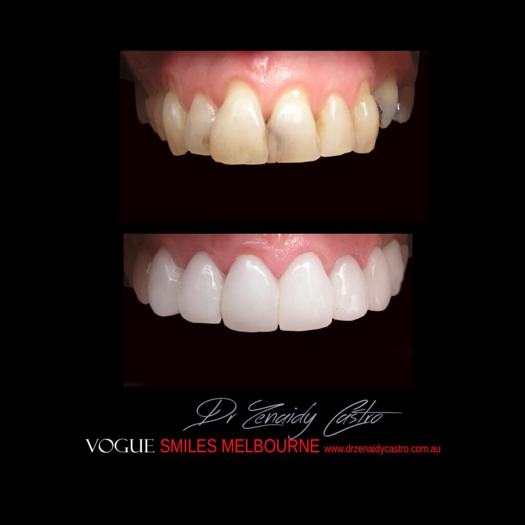 VOGUE-SMILES-COSMETIC-DENTISTRY-TREATMENT-81.jpg