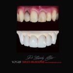 VOGUE-SMILES-COSMETIC-DENTISTRY-TREATMENT-91.jpg