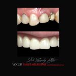 VOGUE-SMILES-COSMETIC-DENTISTRY-TREATMENT-92.jpg