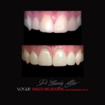 VOGUE-SMILES-COSMETIC-DENTISTRY-TREATMENT-93.jpg