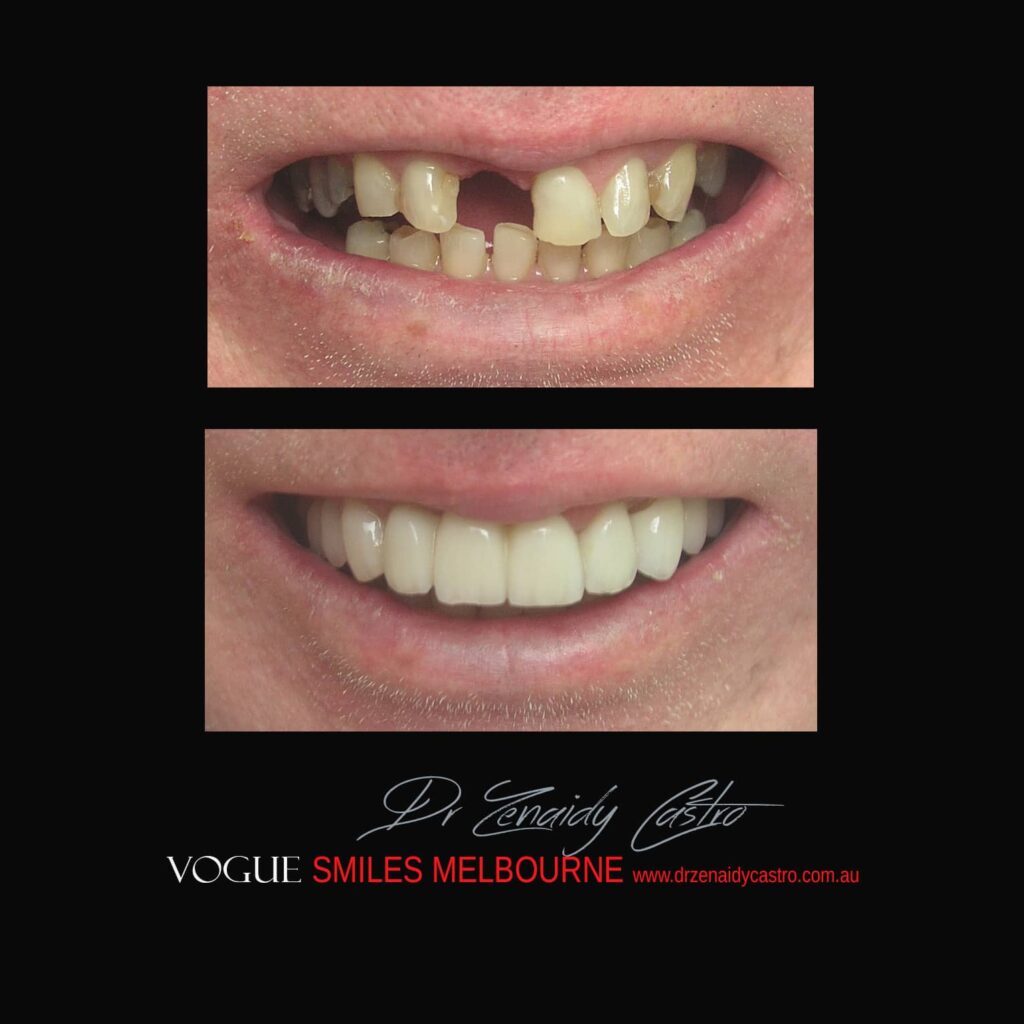 VOGUE-SMILES-COSMETIC-DENTISTRY-TREATMENT-94.jpg