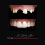 VOGUE-SMILES-COSMETIC-DENTISTRY-TREATMENT-96.jpg