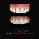 VOGUE-SMILES-COSMETIC-DENTISTRY-TREATMENT-97.jpg
