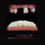 VOGUE-SMILES-COSMETIC-DENTISTRY-TREATMENT-98.jpg