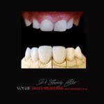 VOGUE-SMILES-COSMETIC-DENTISTRY-TREATMENT-99.jpg