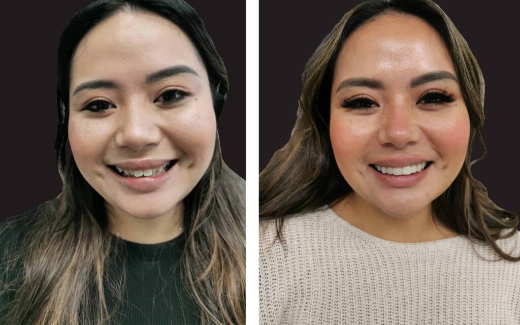 BEFORE-AND-AFTER-SMILE-MAKEOVER-MELBOURNE-1-scaled.jpg