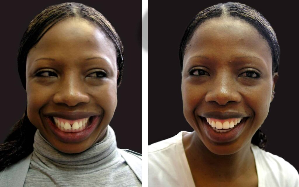 BEFORE-AND-AFTER-SMILE-MAKEOVER-MELBOURNE-2-scaled.jpg