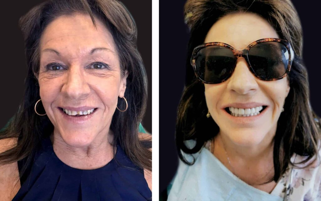 BEFORE-AND-AFTER-SMILE-MAKEOVER-MELBOURNE-4-scaled.jpg