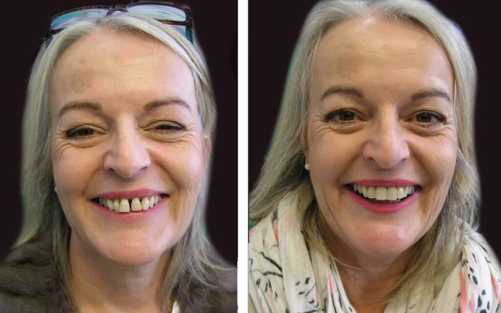 BEFORE-AND-AFTER-SMILE-MAKEOVER-MELBOURNE-5-scaled.jpg