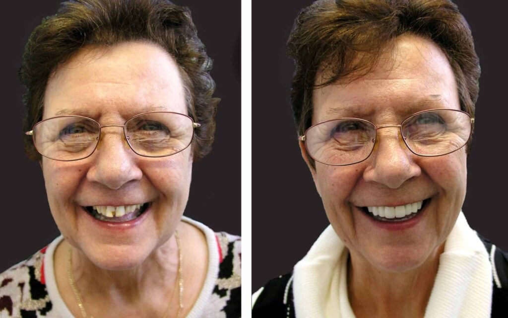 BEFORE-AND-AFTER-SMILE-MAKEOVER-MELBOURNE-6-scaled.jpg