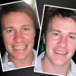 best-Cosmetic-Dentist-in-Melbourne-Before-and-After-v2.jpg